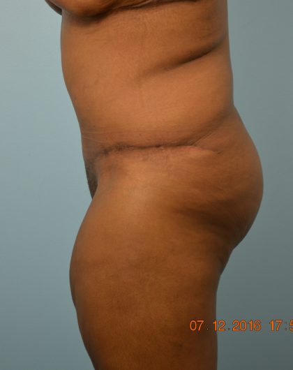 Tummy Tuck Before & After Patient #1577