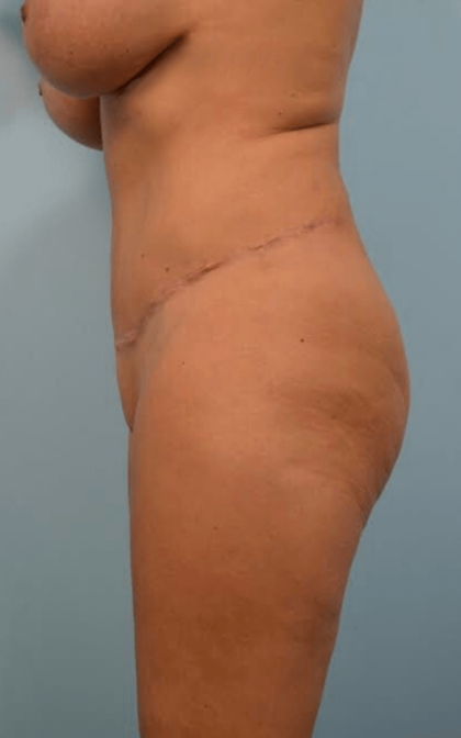 Tummy Tuck Before & After Patient #2306